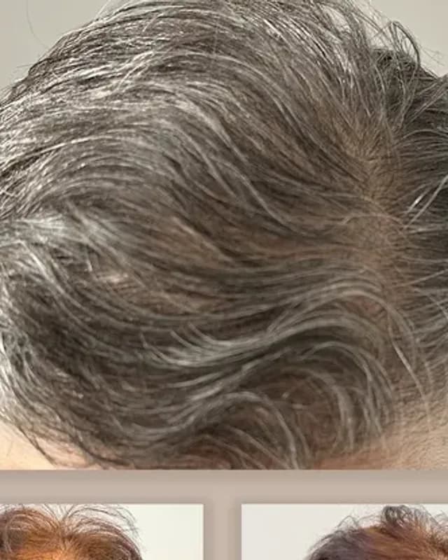 Före och efter hårtransplantation på kvinna, 2 500 grafter med DHI-metoden, resultat efter 12 månader