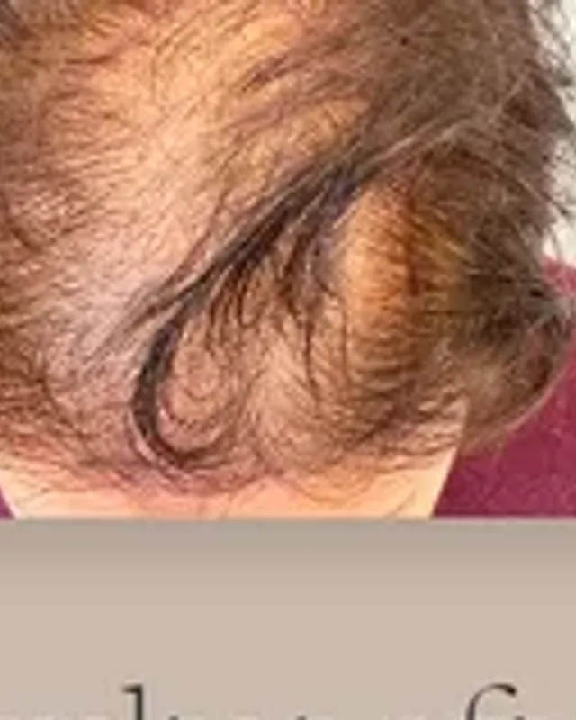 Före hårtransplantation, kvinna