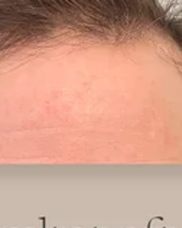 Före hårtransplantation, backande hårlinje