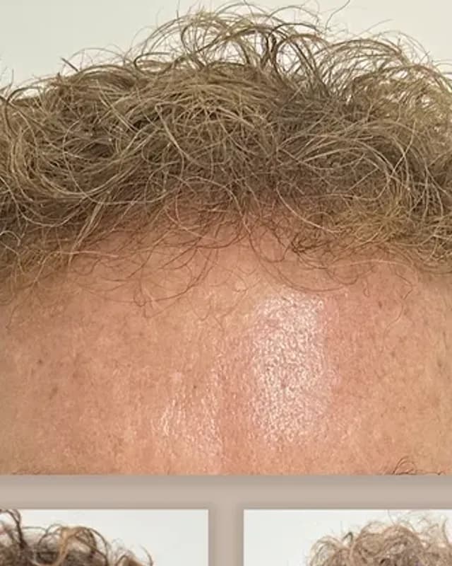 Före och efter hårtransplantation på man, 4 000 grafter med FUE-metoden, resultat efter 12 månader