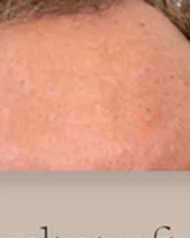 Före hårtransplantation, man