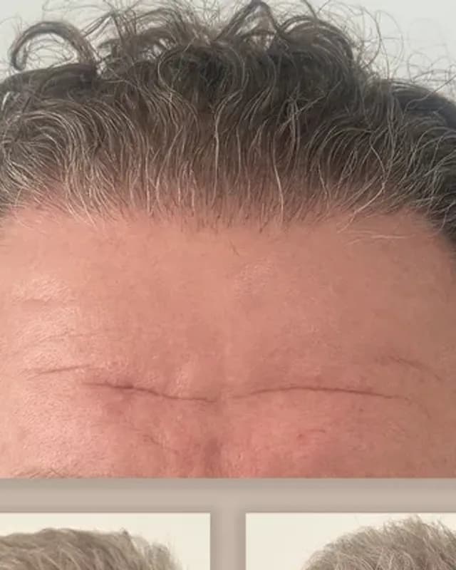 Före och efter hårtransplantation på man, 4 000 grafter med FUE-metoden, resultat efter 12 månader