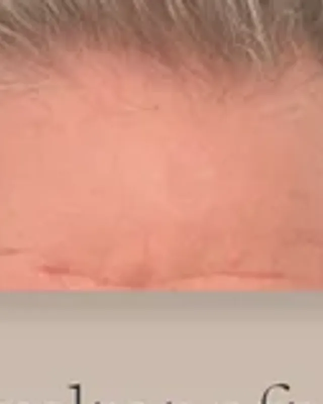 Före hårtransplantation, man