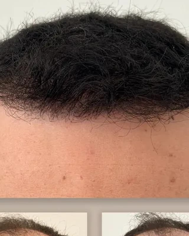 Före och efter hårtransplantation på man, 4 500 grafter med FUE-metoden, resultat efter 12 månader