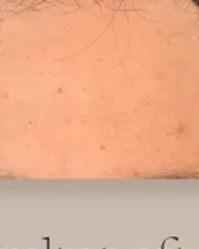 Före hårtransplantation, man