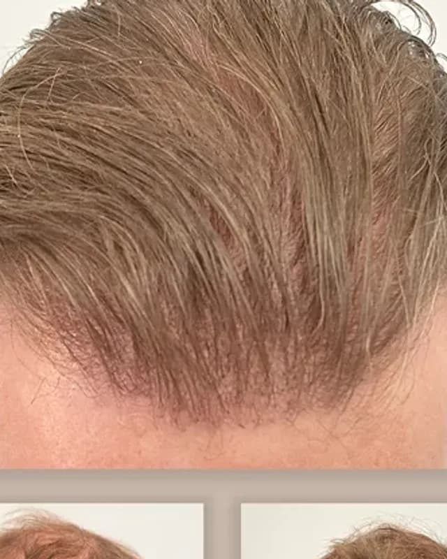 Före och efter hårtransplantation på man, 4 000 grafter med FUE-metoden, resultat efter 12 månader