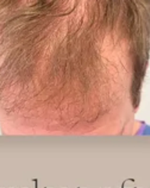 Före hårtransplantation, man