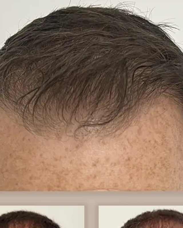 Före och efter hårtransplantation på man, 3 000 grafter med DHI-metoden, resultat efter 12 månader