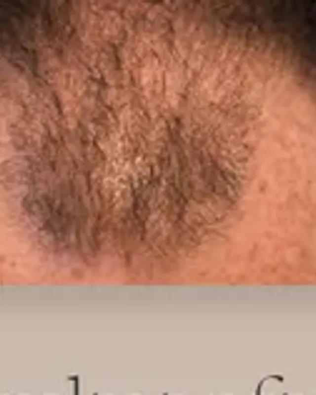 Före hårtransplantation, man