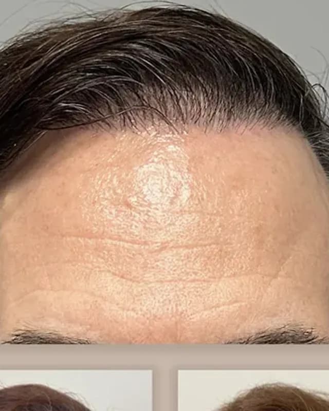 Före och efter hårtransplantation på man, 4 500 grafter med DHI-metoden, resultat efter 18 månader