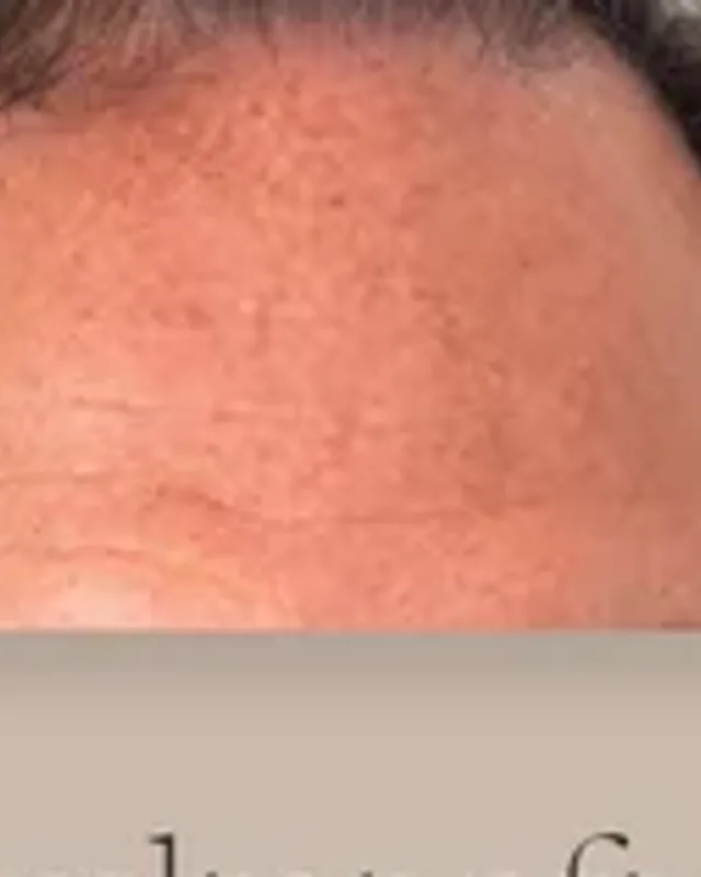 Före hårtransplantation, man