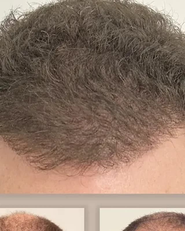Före och efter hårtransplantation på man, 1 500 grafter med FUE-metoden, resultat efter 12 månader