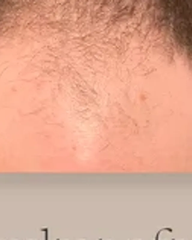 Före hårtransplantation, man