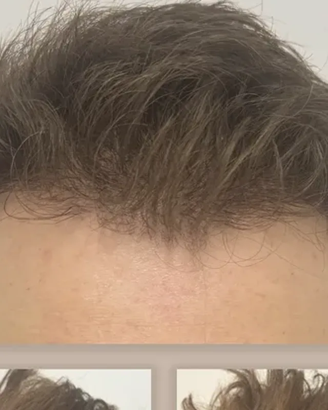 Före och efter hårtransplantation på man, 2 000 grafter med FUE-metoden, resultat efter 7 månader