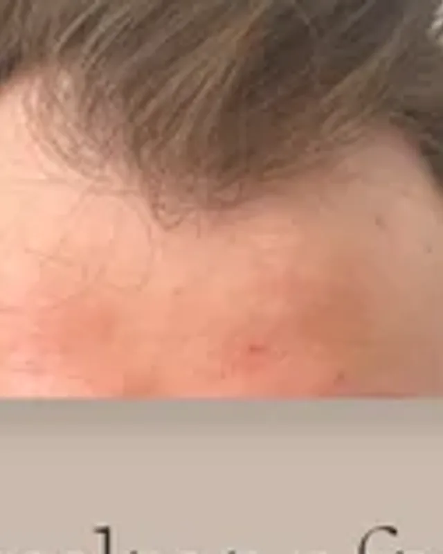 Före hårtransplantation, man