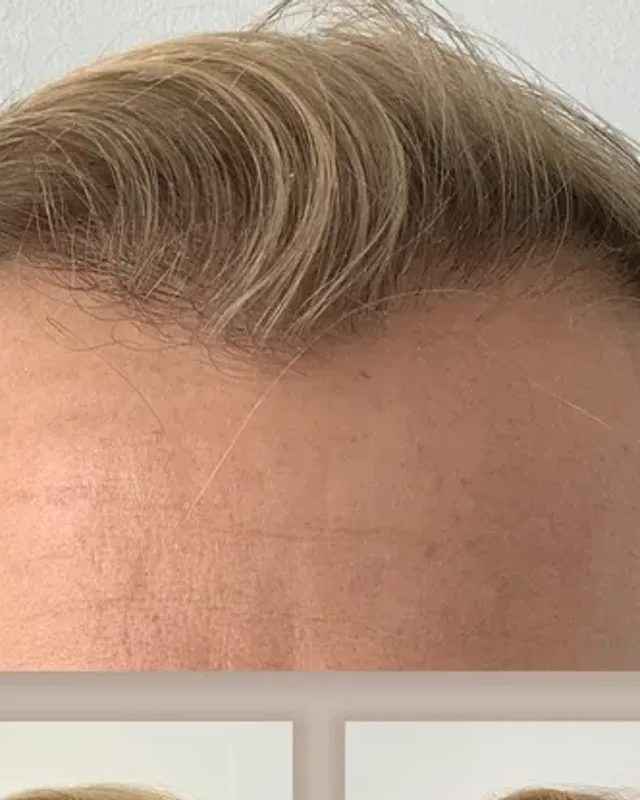 Före och efter hårtransplantation på man, 4 000 grafter med DHI-metoden, resultat efter 8 månader