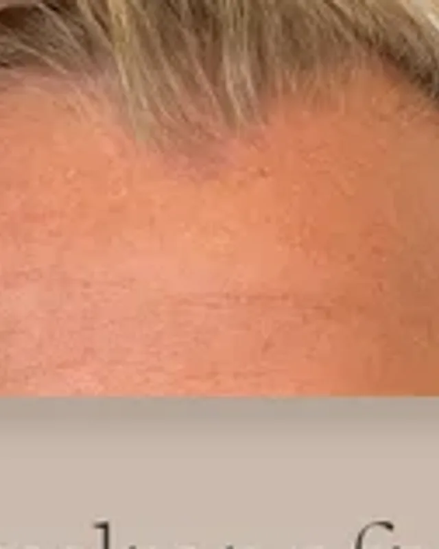 Före hårtransplantation, man