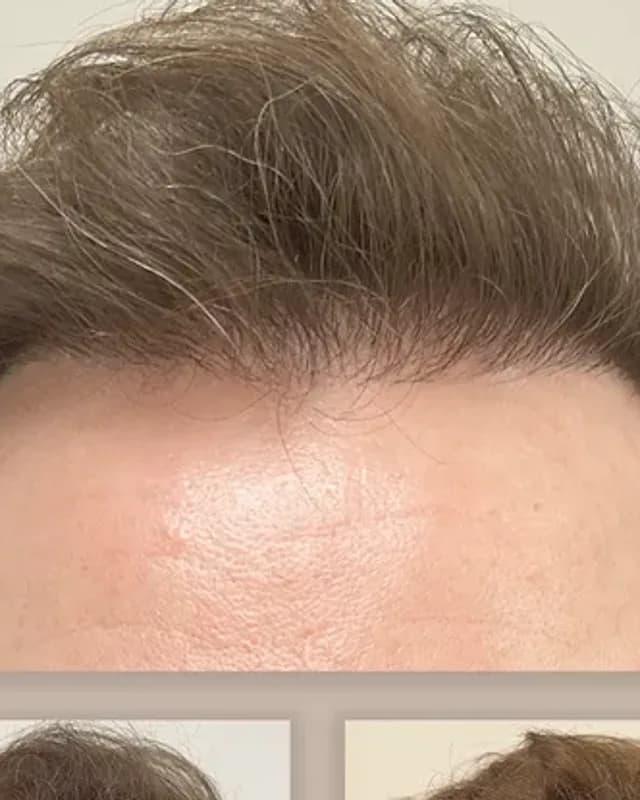 Före och efter hårtransplantation på man, 2 000 grafter med DHI-metoden, resultat efter 8 månader