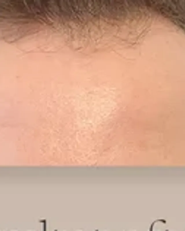 Före hårtransplantation, man