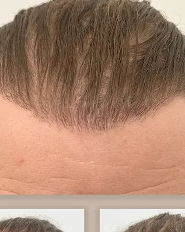 Före och efter hårtransplantation på man, 2 000 grafter med DHI-metoden, resultat efter 12 månader