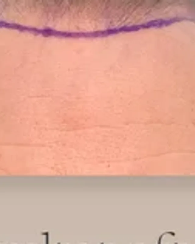 Före hårtransplantation, man