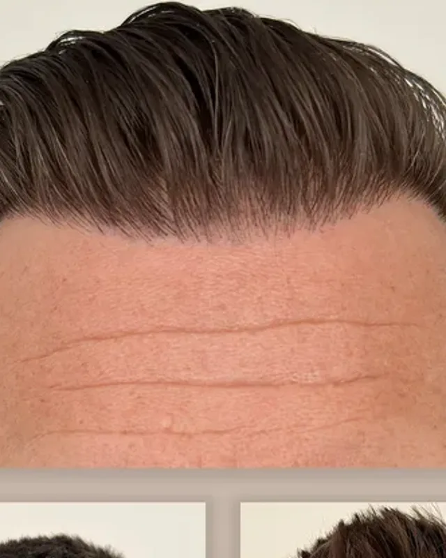 Före och efter hårtransplantation på man, 2 500 grafter med FUE-metoden, resultat efter 12 månader
