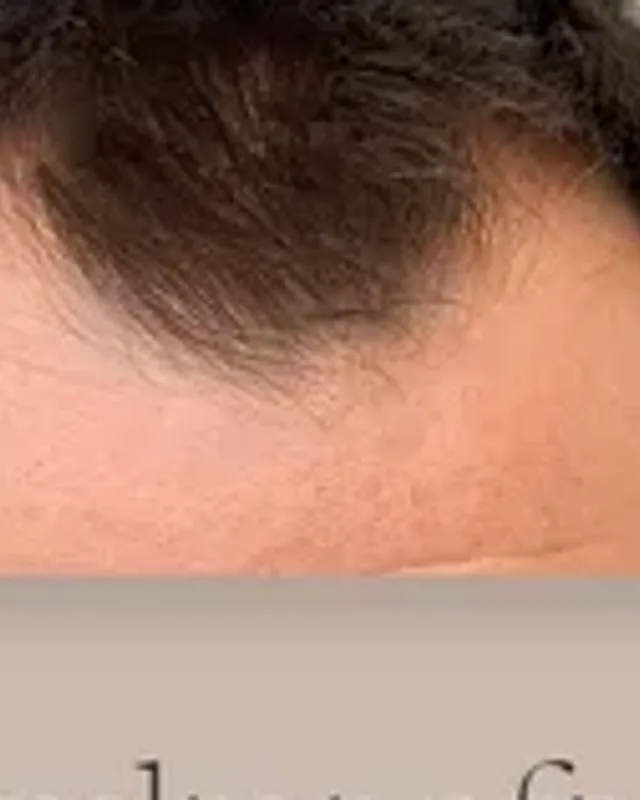 Före hårtransplantation, man