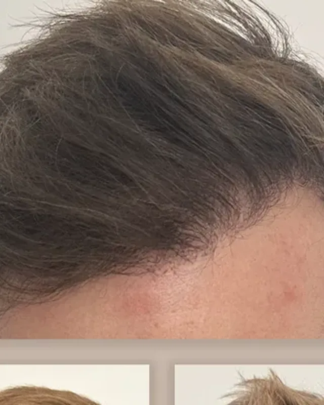 Före och efter hårtransplantation på man, 3 000 grafter med FUE-metoden, resultat efter 12 månader