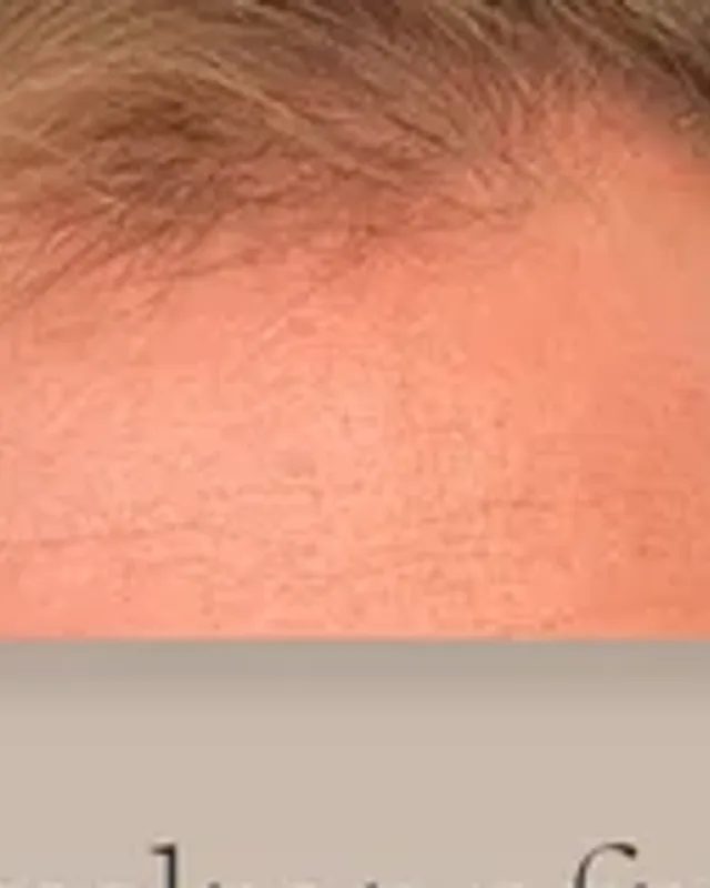 Före hårtransplantation, man