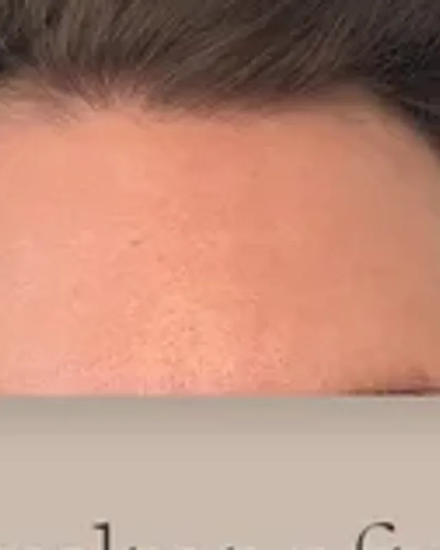 Före hårtransplantation, man