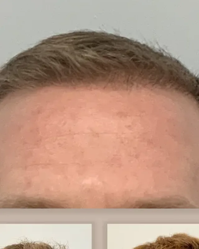 Före och efter hårtransplantation på man, 1 500 grafter med DHI-metoden, resultat efter 5 månader