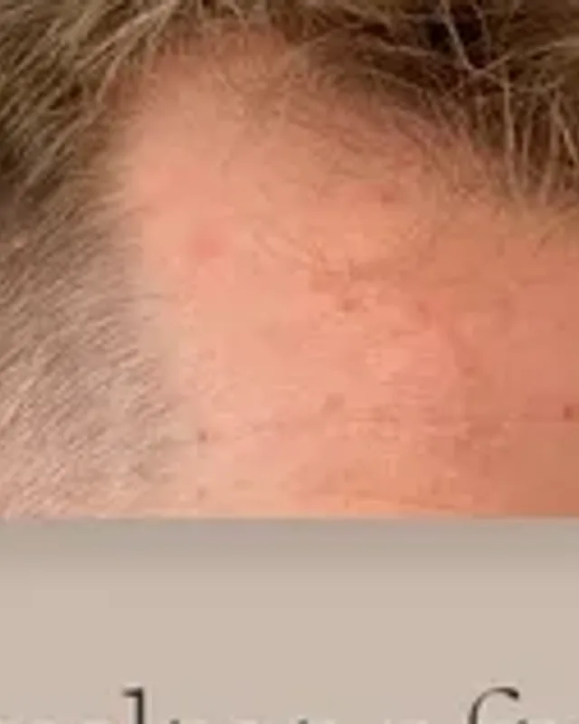 Före hårtransplantation, man