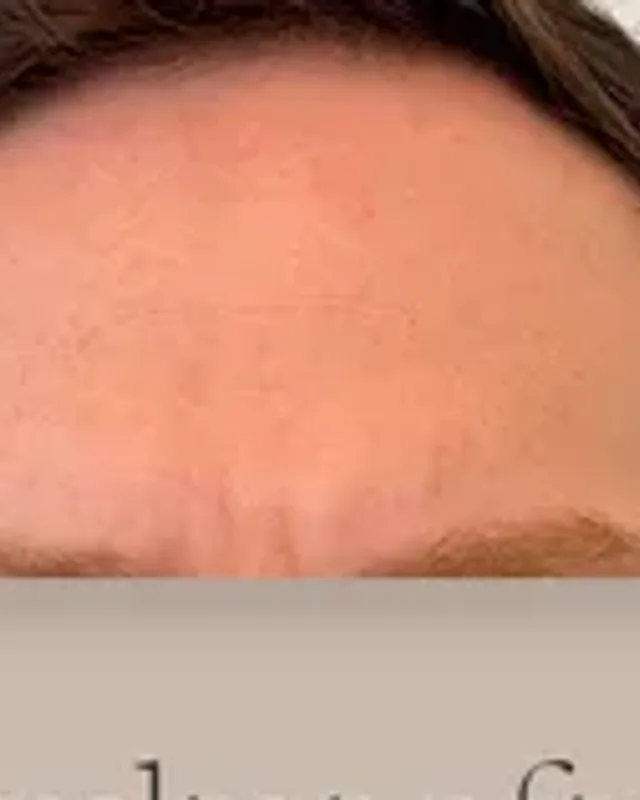 Före hårtransplantation, man