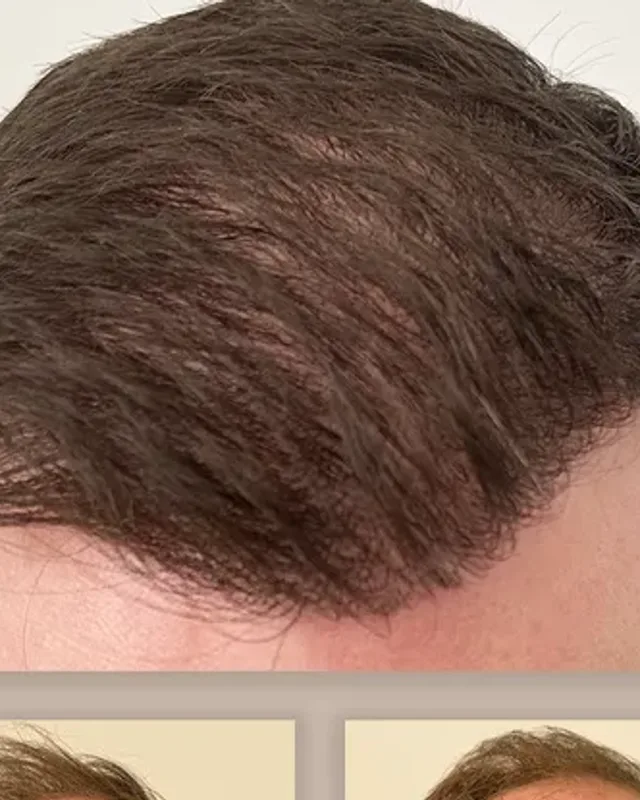 Före och efter hårtransplantation på man, 4 000 grafter med FUE-metoden, resultat efter 12 månader