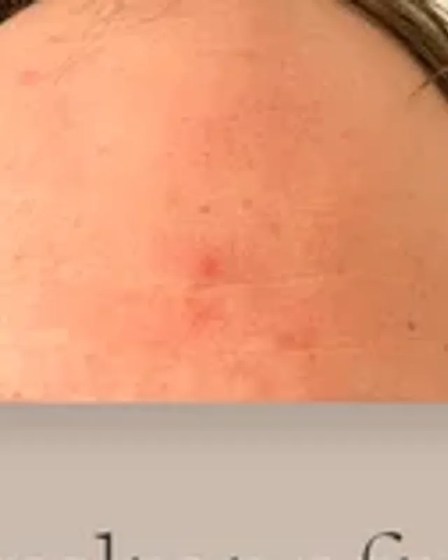 Före hårtransplantation, man