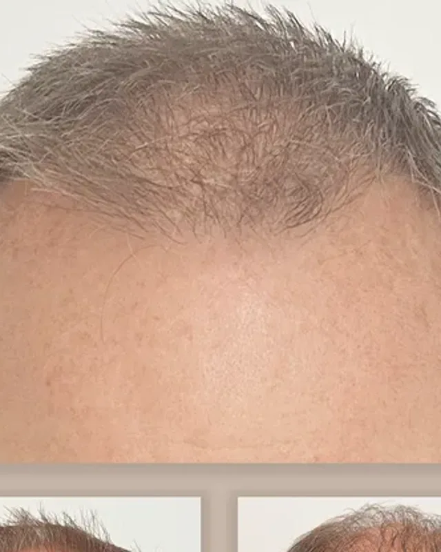 Före och efter hårtransplantation på man, 4 000 grafter med FUE-metoden, resultat efter 18 månader