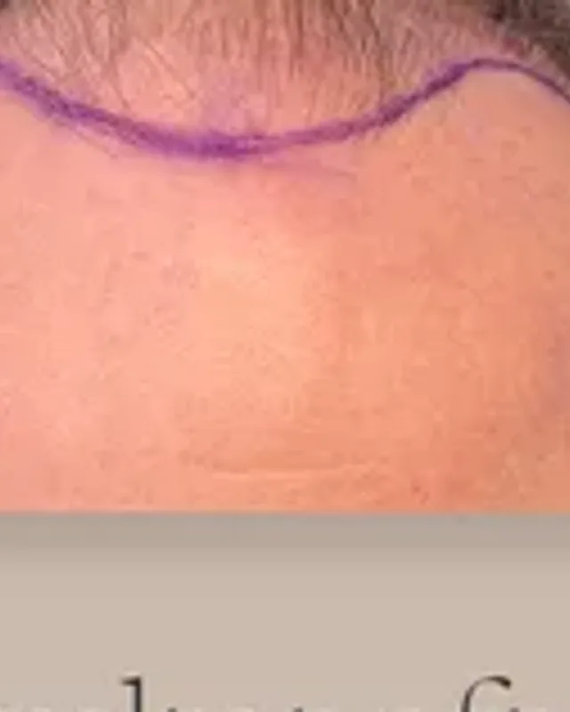Före hårtransplantation, man