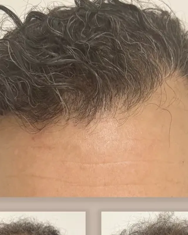 Före och efter hårtransplantation på man, 4 000 grafter med FUE-metoden, resultat efter 12 månader