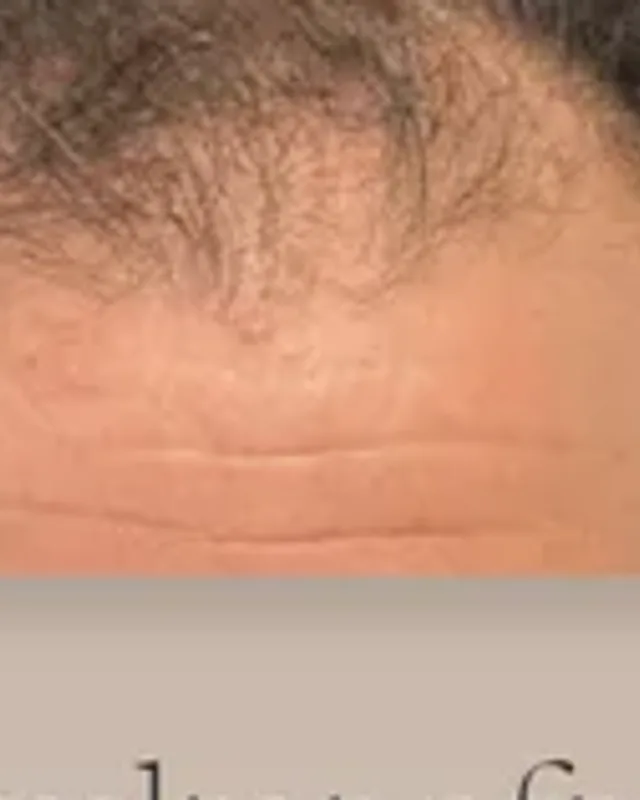 Före hårtransplantation, man